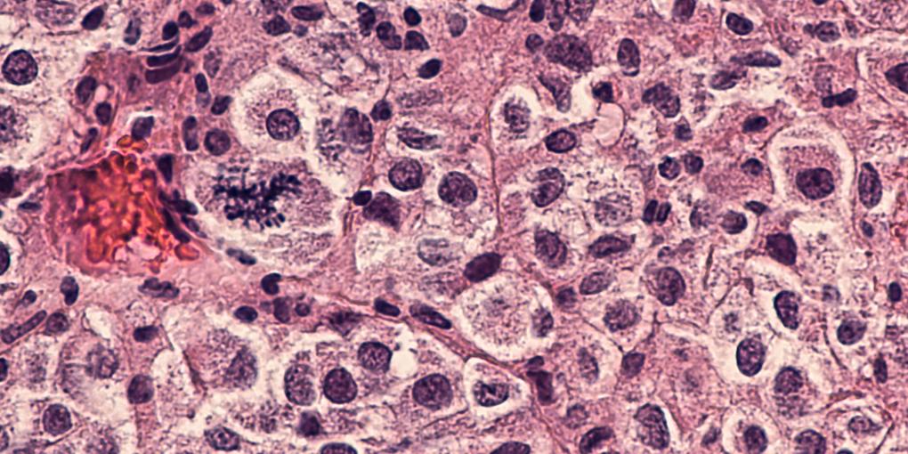 Melanoma Melanoma
